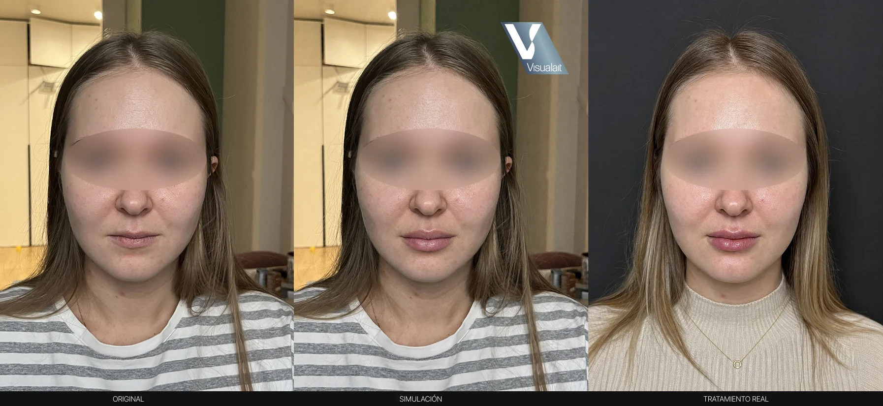 Tres fotos de frente de la misma mujer: sus labios originales, la simulación de Visualait y el resultado del tratamiento real.